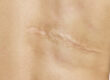 Scar after operation on back of women on white background