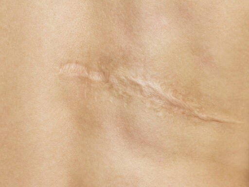 Scar after operation on back of women on white background Scar after operation on back of women on white background